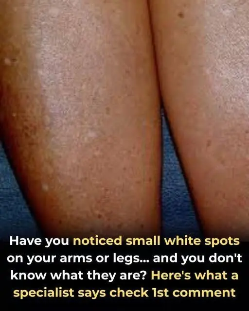 White Spots on Your Skin? What Dermatologists Want You to Know