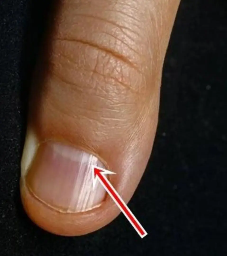 Your Nails Could Be Sending Warning Signs — Especially After 40