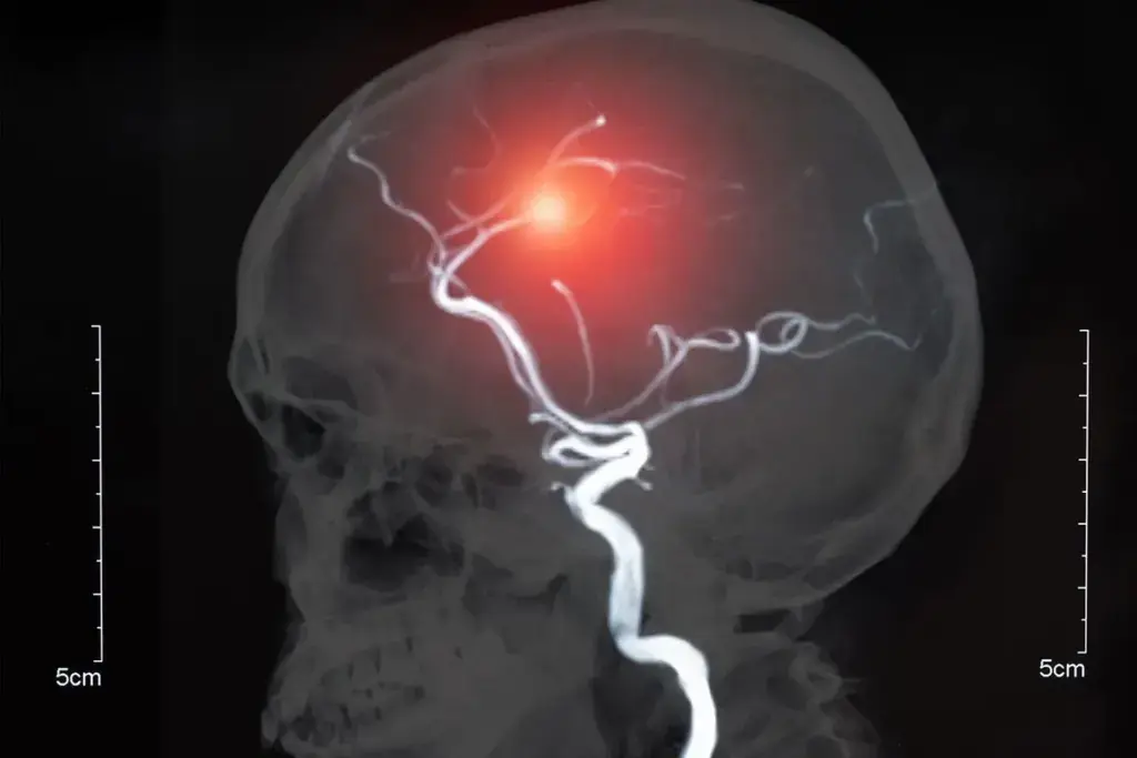 These Common Symptoms Could Be Linked to a Dangerous Aneurysm