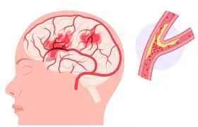 A Mini Stroke May Be Warning You—Here Are 5 Signs You Shouldn't Ignore