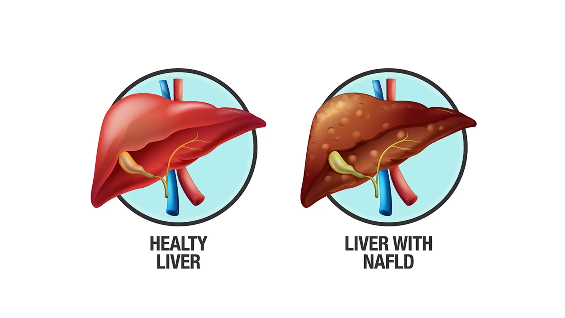 Fatty Liver Disease: Symptoms, Causes, and What You Can Do to Support Your Liver