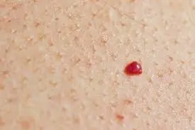 Noticing Red Spots on Your Skin? Here's Why You Should Pay Attention