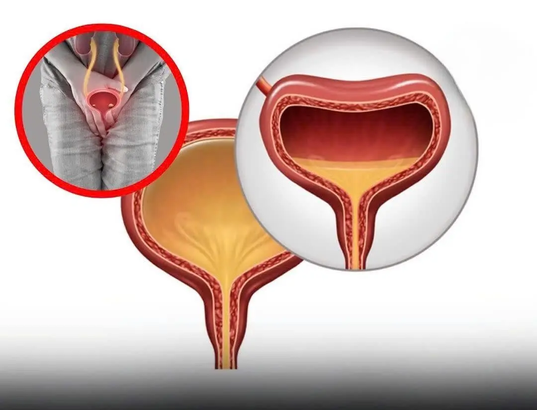 These Early Signs of Bladder Cancer Are Easy to Miss