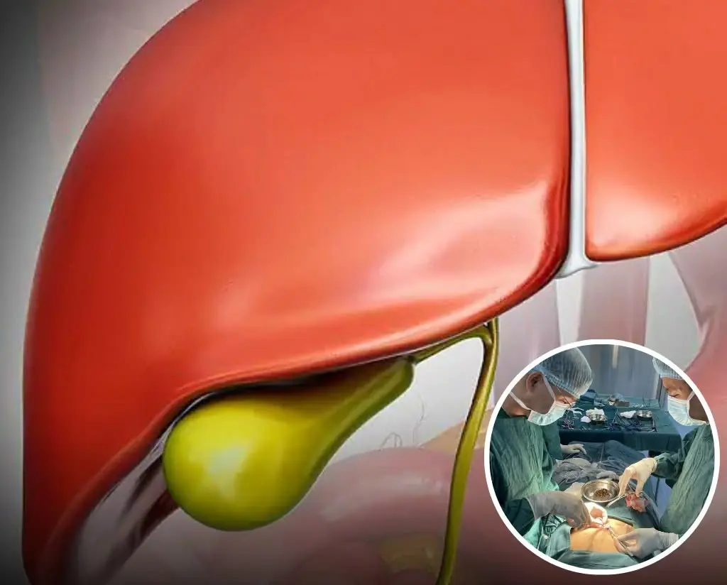What Happens to the Body After G.allb.la.dder Removal?