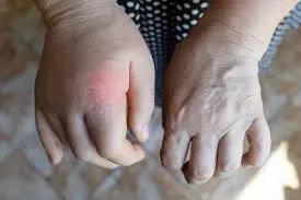 Notice Swelling in Your Hands and Feet? It Could Be More Than Just Fatigue