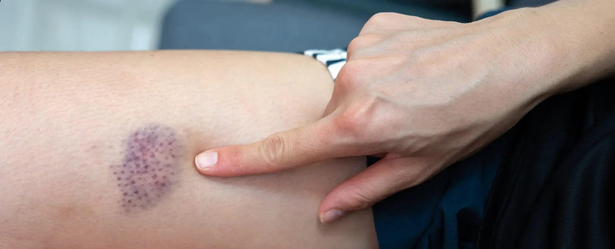 The Truth About Unexplained Bruises May Surprise You...