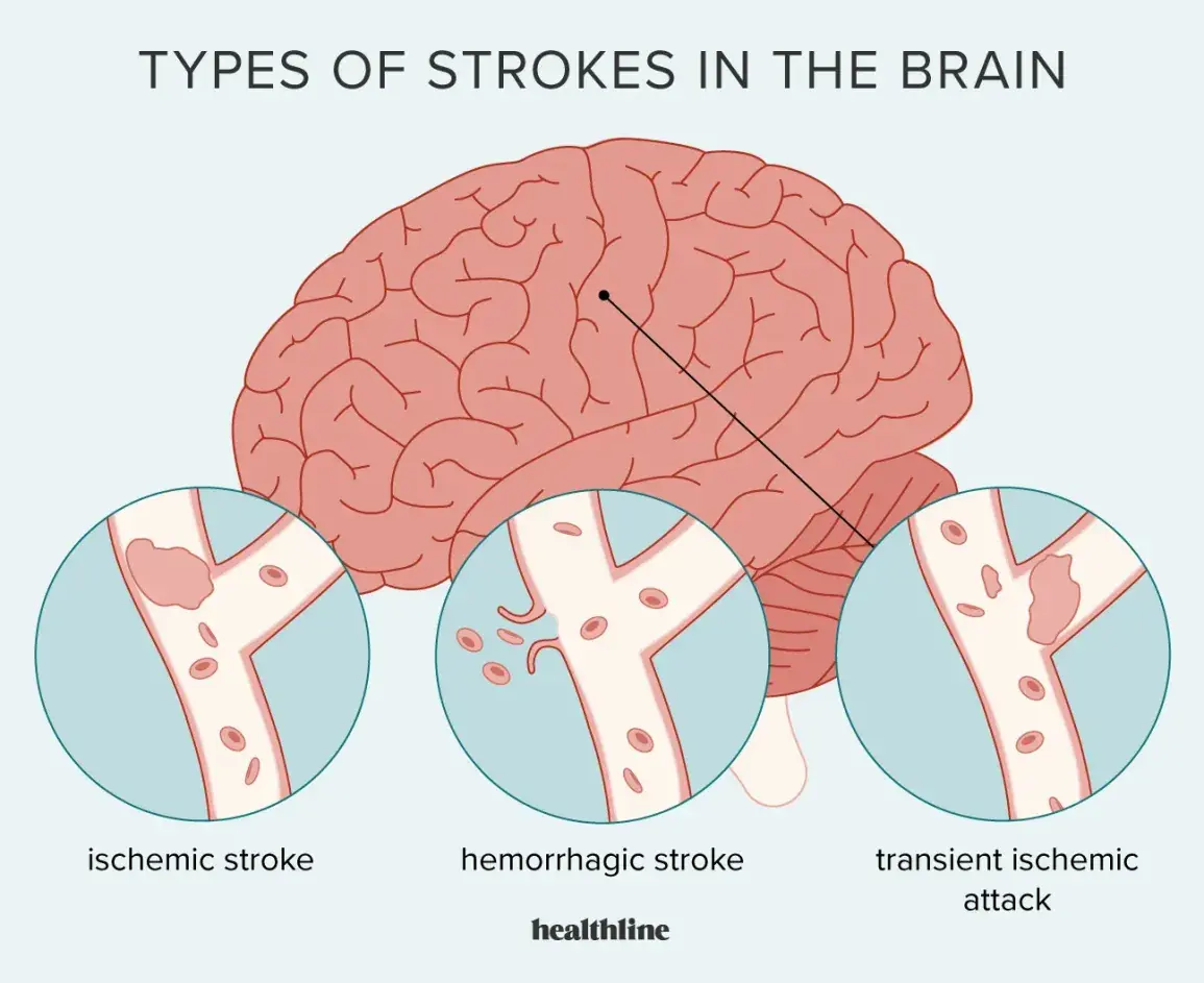 Stroke Can Strike Without Warning — These 10 Symptoms Could Be Life-Saving to Recognize