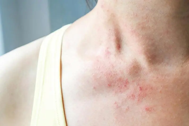 These Red Dots on Your Skin May Mean More Than You Think