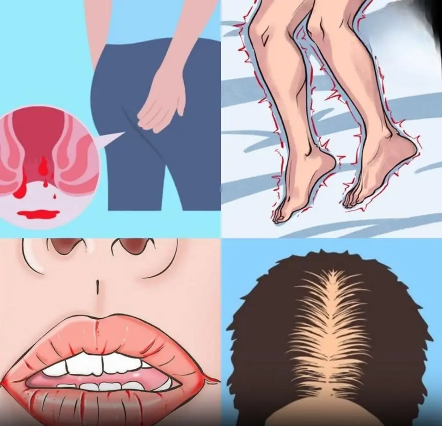These signs could be linked to Vitamin B12 deficiency