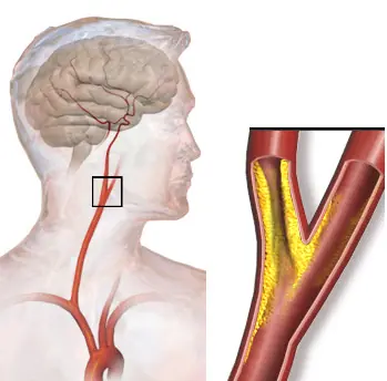 Many People Ignore These Signs Until It’s Too Late — 10 Possible Symptoms of Clogged Arteries