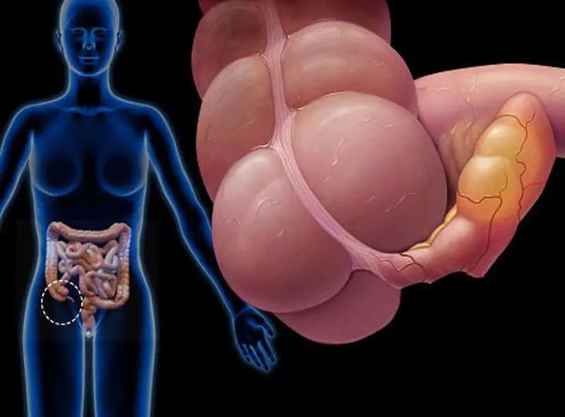 These 9 Symptoms May Appear Before Appendicitis Requires Emergency Treatment