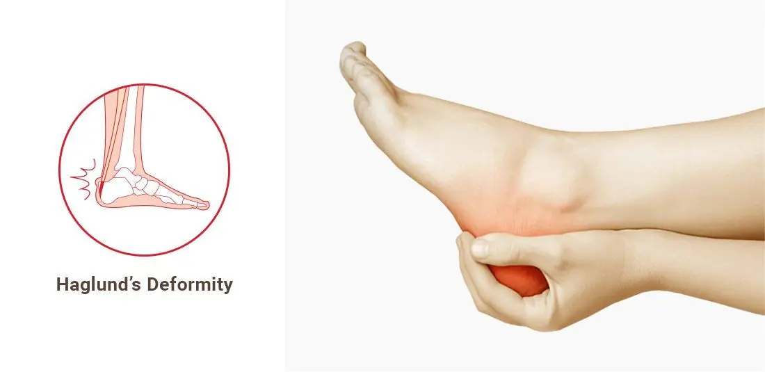 If Your Heel Hurts Even Without Standing Much, Here's What Experts Say It Could Mean
