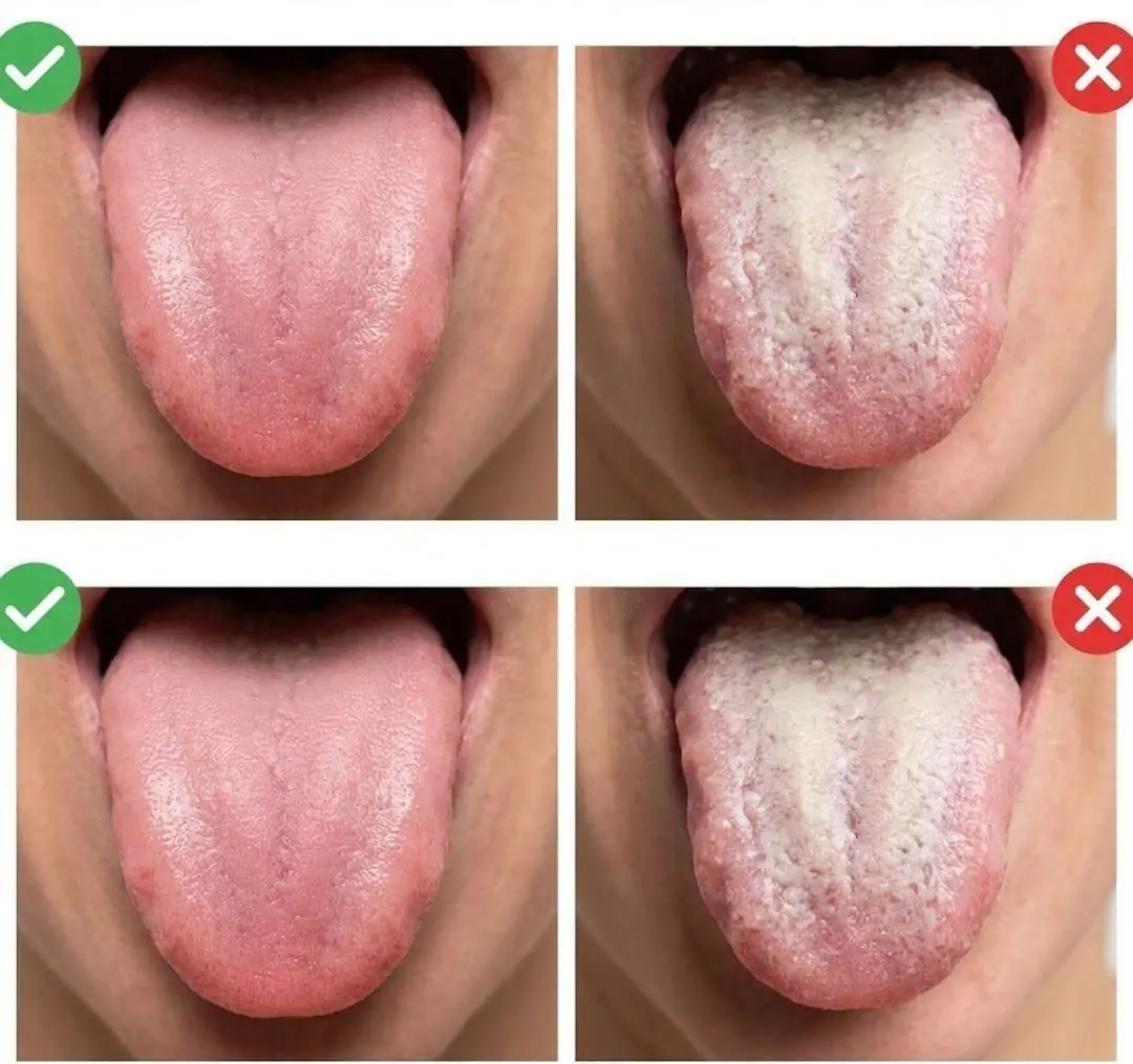 A White Tongue May Be Telling You More About Your Health Than You Think