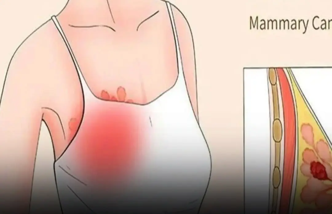 Early Bre:ast Can:cer Symptoms That Often Go Unnoticed — What Doctors Want You to Know