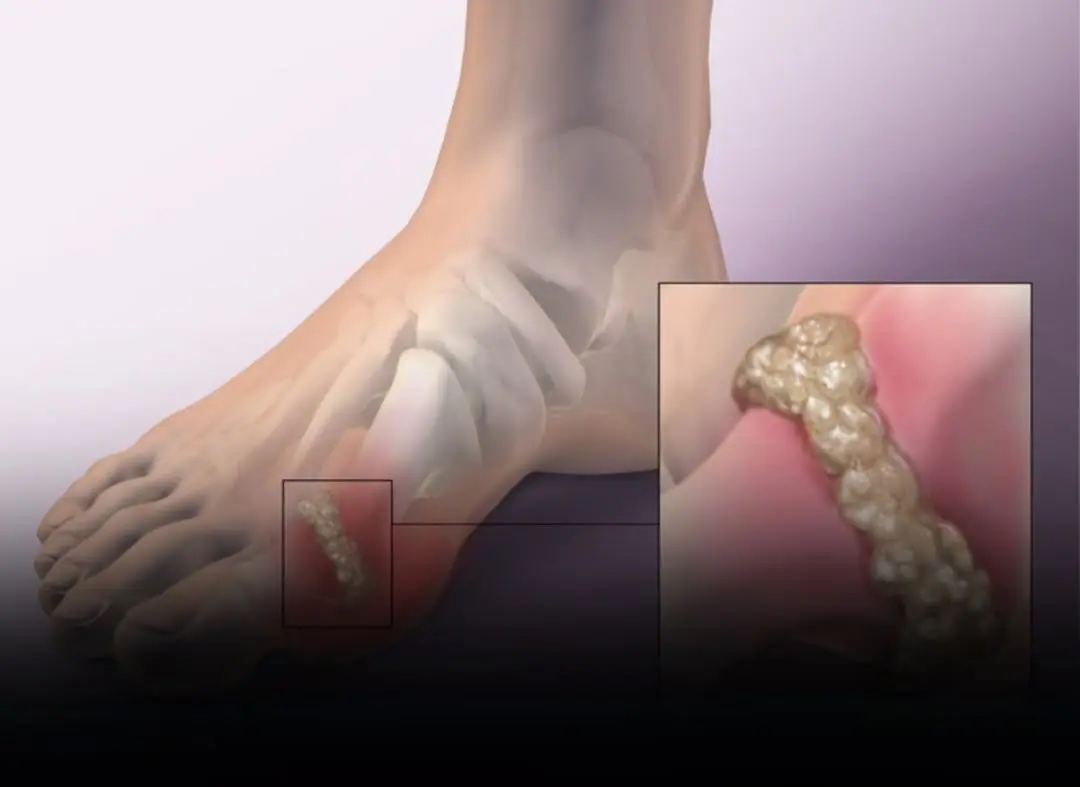 Gout is an increasingly common condition among many people. Those with gout should absolutely avoid these foods