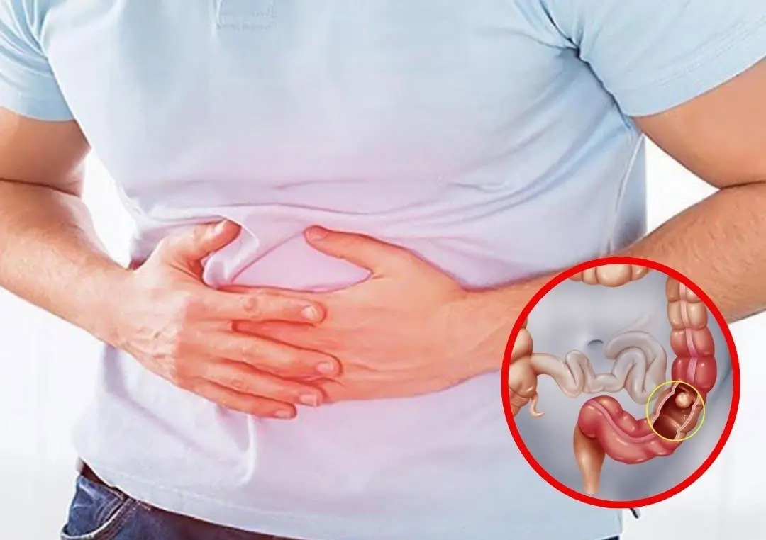 Colon can.cer, also known as colorectal can.cer, is one of the most common
