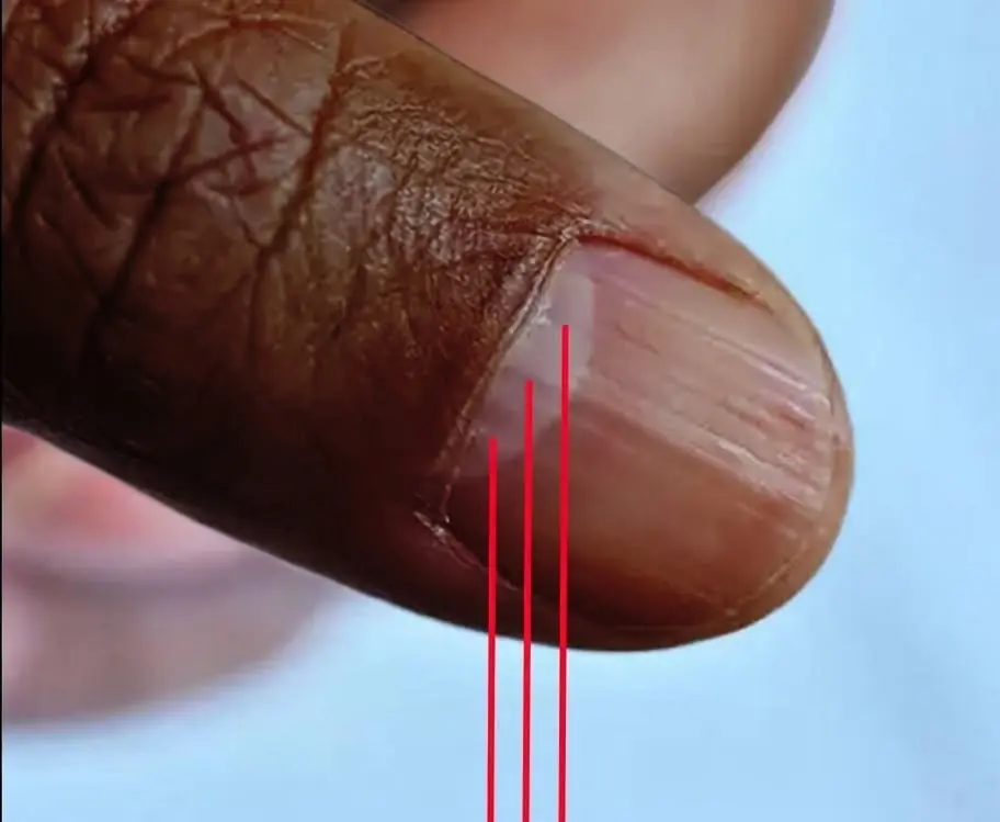 Changes in your nails, including lines or ridges, can sometimes reflect your overall healt