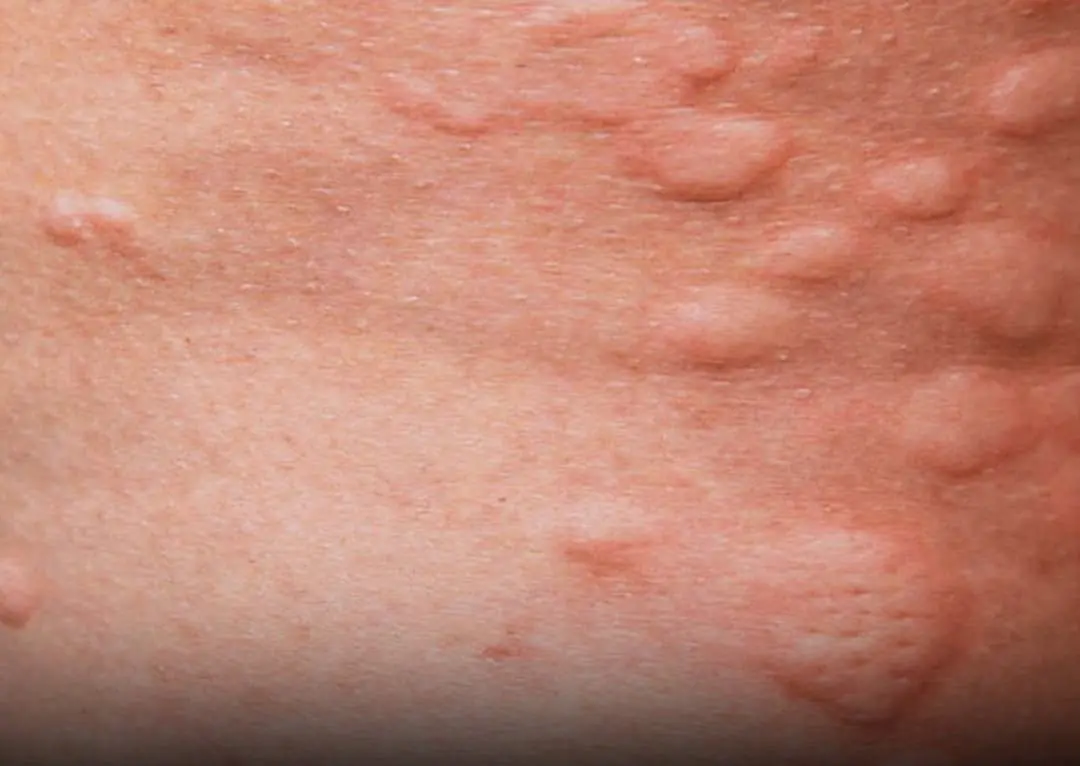 Why Is Your Skin Itchy with Bumps? The Possible Causes Explained…