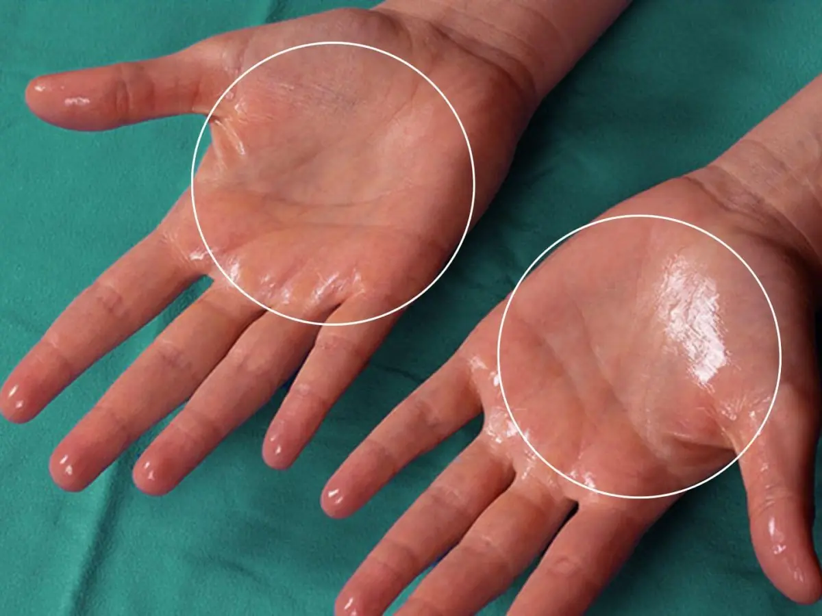 Abno.rmal sweating in the following six patterns may be a sign of various dise.ases
