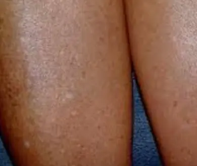 Have you noticed small white spots on your arms or legs… and you don't know what they are?