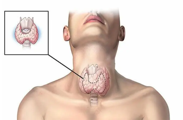 7 Changes in Your Body That Could Be Early Signs of Thyroid Cancer