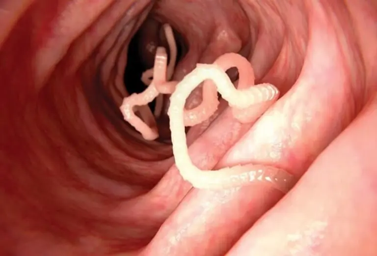 5 Surprising Symptoms That May Occur When Parasites Overgrow in the Body