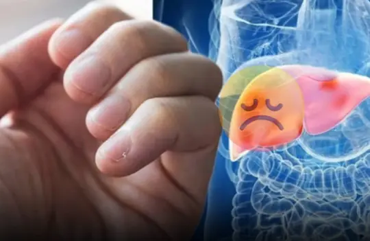 3 Hand Signs That May Signal Liver Failure — Even 1 Is a Reason to See a Doctor Immediately!