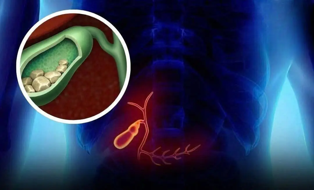 These 6 Often-Ignored Symptoms Could Signal Serious Gallbladder Health Issues