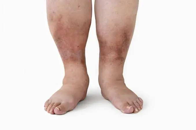Your Swollen Legs May Be More Than Just Fatigue — Learn the Possible Causes