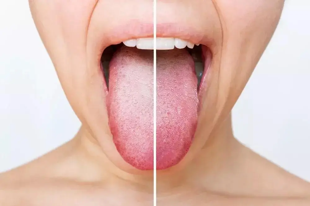If Your Tongue Looks Like This, It Could Be a Sign of Iron Deficiency: Symptoms You Shouldn't Ignore
