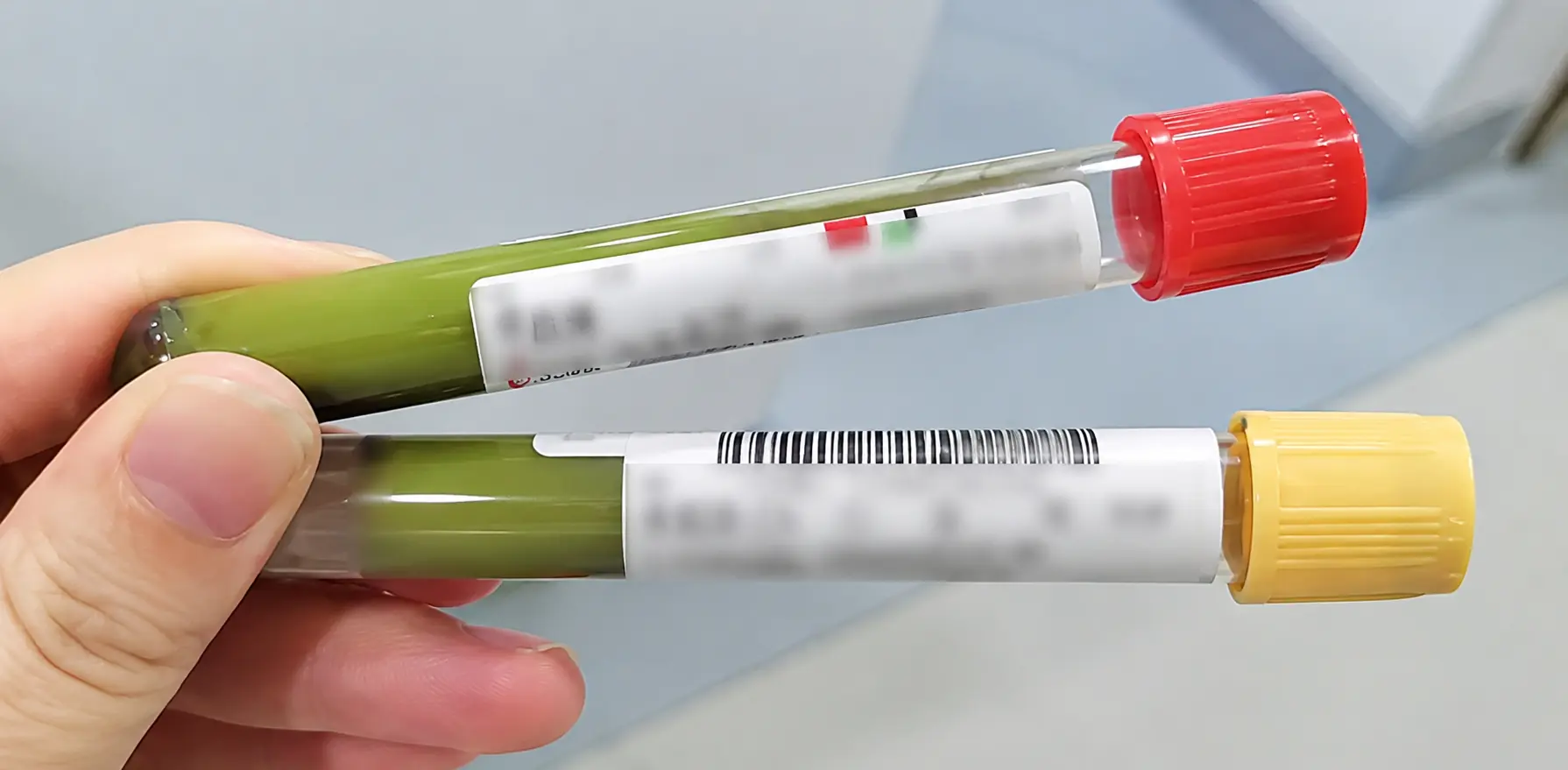 Man, 36, Shocked After His Blo.od Turned Green: Doctors Trace It to a Familiar Herbal Drink