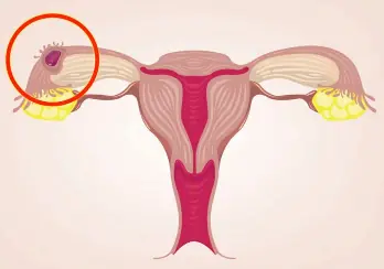 Women Who Frequently Eat These 5 Foods May Be Harming Their Uterus and Feeding Cancer Cells Without Knowing It