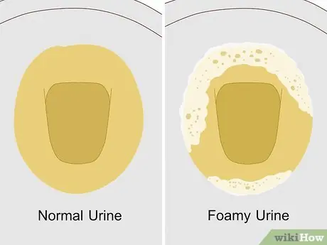 Seeing Bubbles in Your Urine? Experts Say It Could Be Worth Paying Attention To