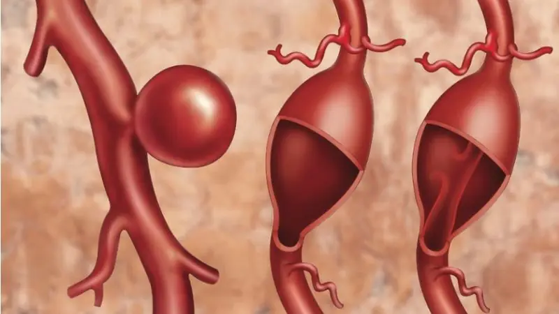 The Silent Danger of Aneurysms: Symptoms to Be Aware Of
