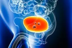 These Common Symptoms Could Be Early Signs of Bladder Cancer