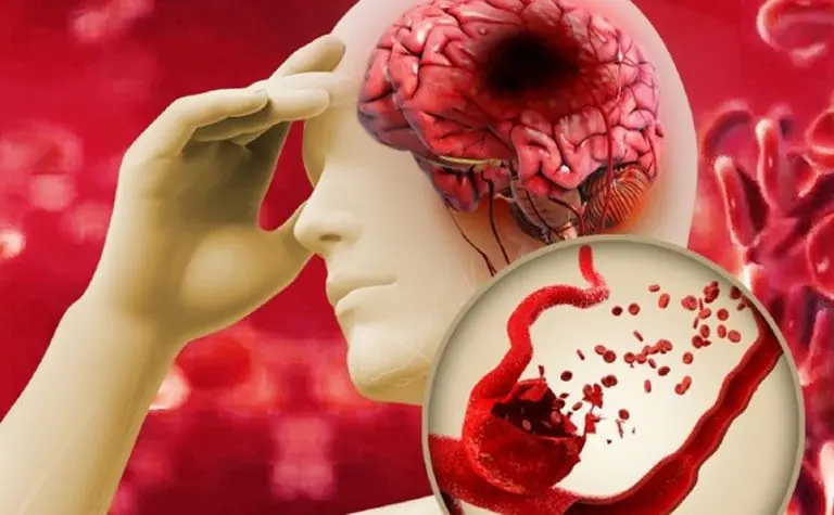 These Symptoms Could Point to an Aneurysm — Knowing Them May Save a Life
