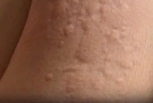 His Whole Body Was Itchy—He Thought It Was an Allergy. But the Diagnosis Changed Everything.