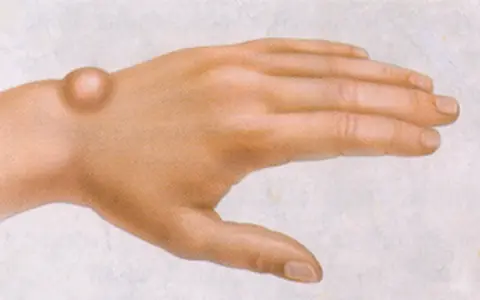 A Common Routine May Be Linked to This Mysterious Lump—Experts Explain
