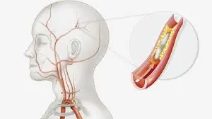 Your Body Could Be Showing These 10 Signs of Clogged Arteries
