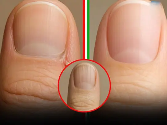 5 Silent Health Problems Your Nails Reveal Before Anything Else