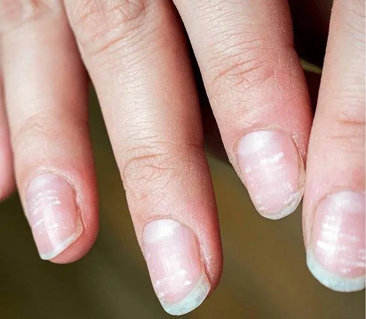 Your Fingernails May Be Warning You: 9 Signs to Watch For