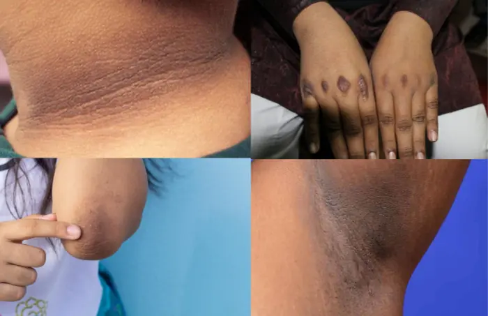 An 18-Year-Old Man Discovered He Had Diab.etes Because of a Change in His Skin