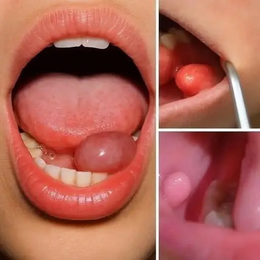 A Small Lump in the Mouth? Here Are the Early Symptoms You Shouldn’t Ignore
