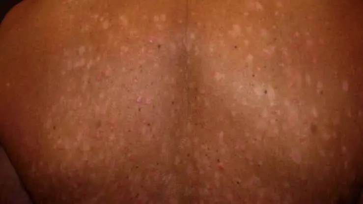 Small White Spots on Skin Are Common—But Don’t Ignore These Details