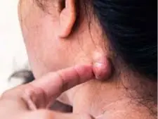 A Small Lump in These Areas of Your Body Could Be Trying to Tell You Something