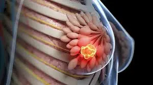 Breast Cancer Often Starts With Subtle Symptoms—Here Are 10 Signs to Watch For