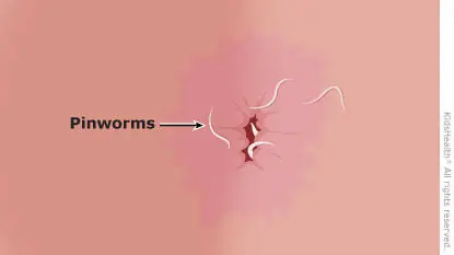 Pinworms in Children Could Be Behind Nighttime Itching—Here’s What to Know