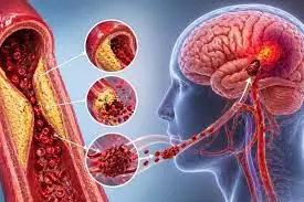 6 Arm and Leg Symptoms That Often Appear at Night Before a Stroke
