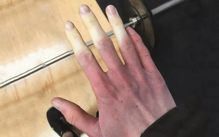 If Your Fingers Turn White in the Cold, Your Body May Be Warning You About Something