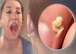 Noticing White Spots or Bumps in Your Mouth? Don't Ignore These Possible Causes